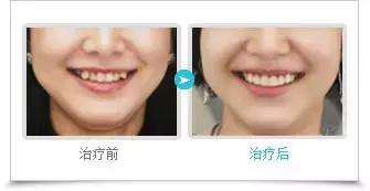 虎牙矫正的较好方法之一通过正畸来矫正虎牙